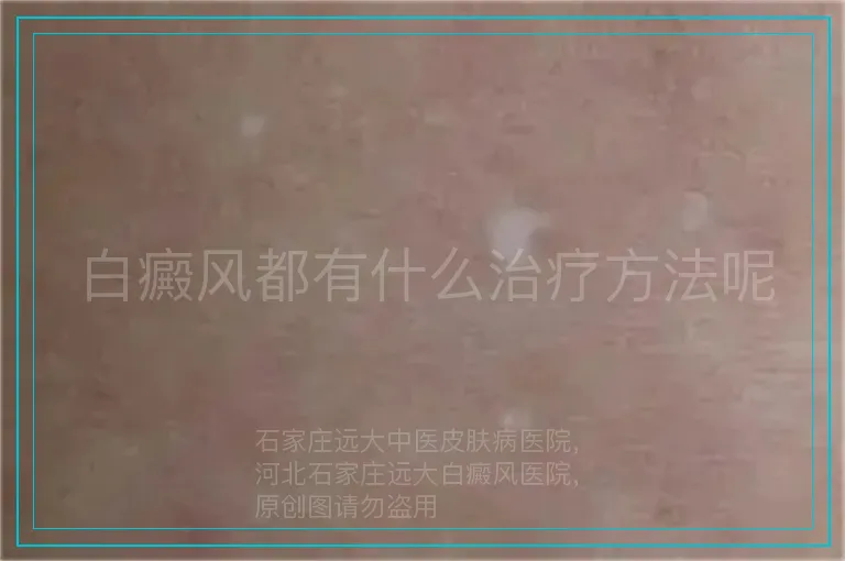 白癜风都有什么治疗方法呢