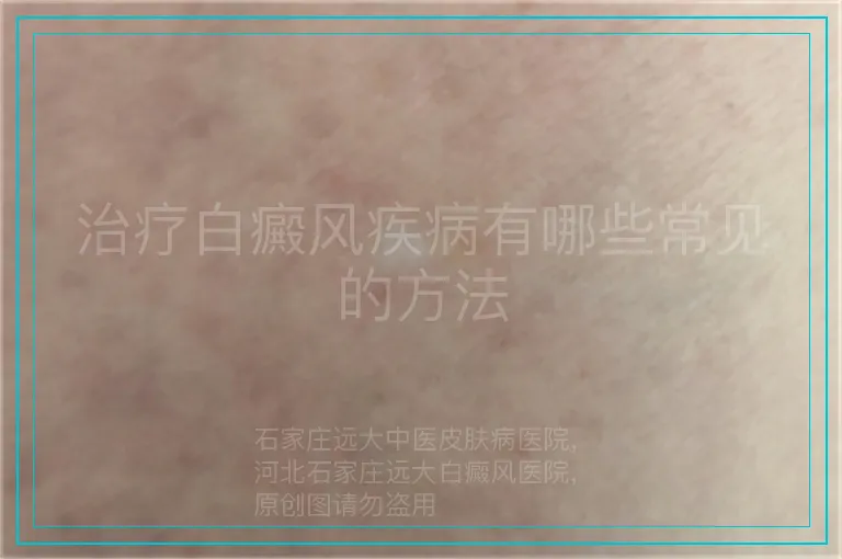 治疗白癜风疾病有哪些常见的方法