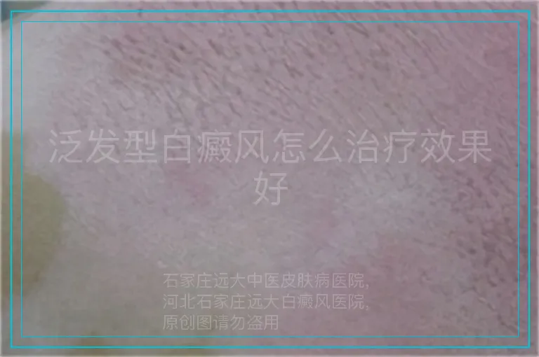 泛发型白癜风怎么治疗效果好