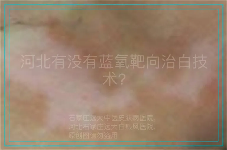 河北有没有蓝氧靶向治白技术?