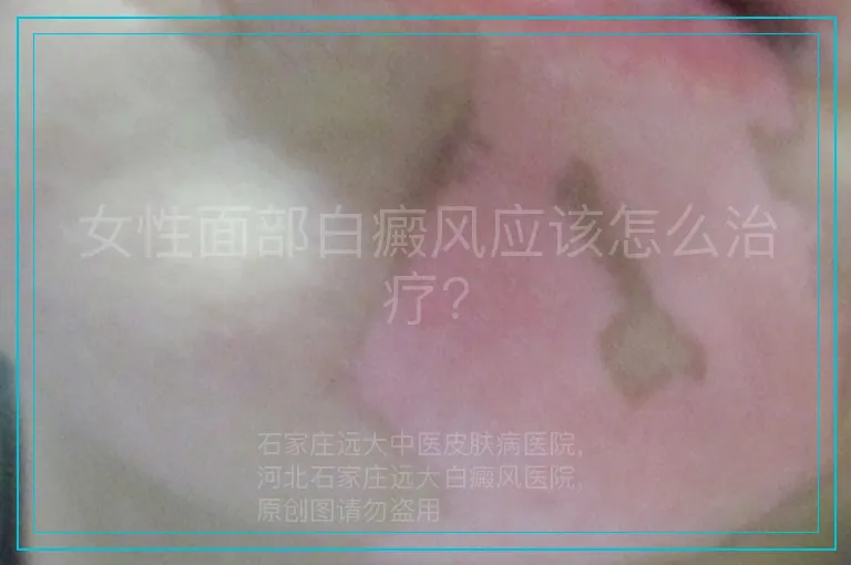 女性面部白癜风应该怎么治疗?