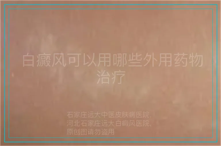 白癜风可以用哪些外用药物治疗