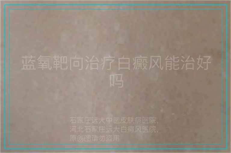 蓝氧靶向治疗白癜风能治好吗