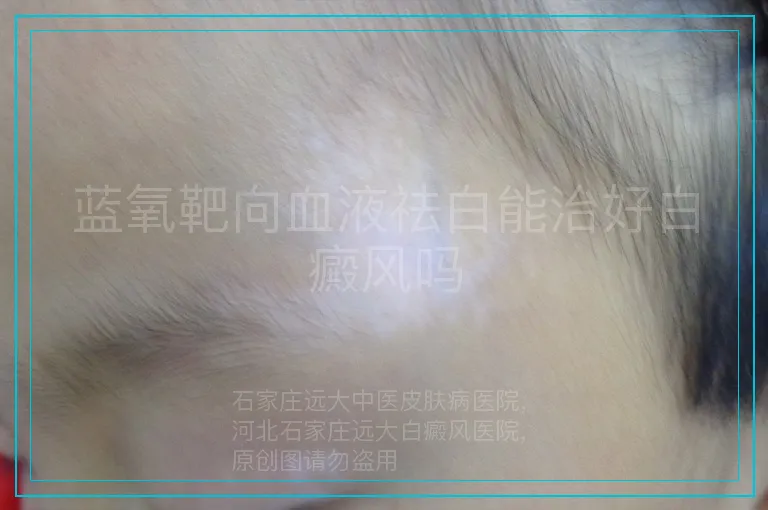 蓝氧靶向血液祛白能治好白癜风吗