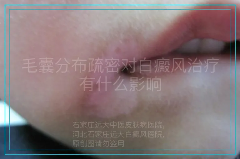 毛囊分布疏密对白癜风治疗有什么影响
