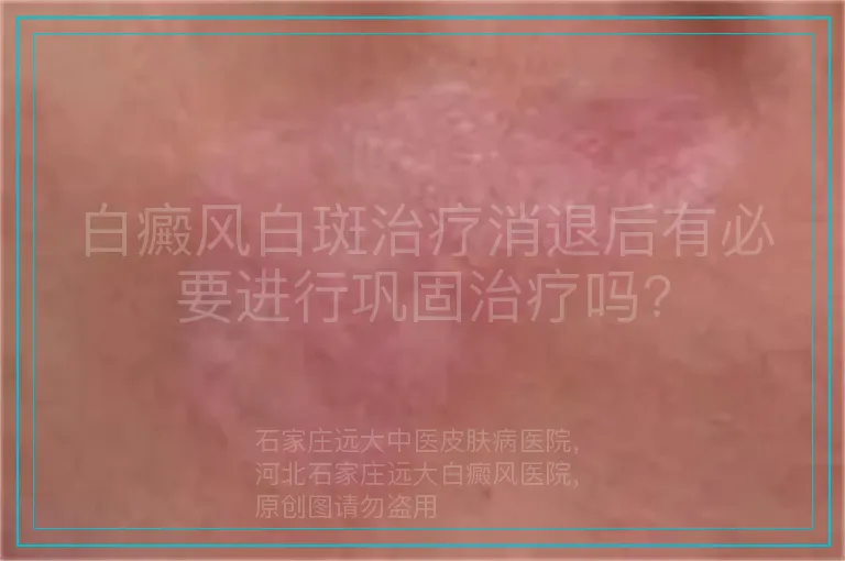 白癜风白斑治疗消退后有必要进行巩固治疗吗?