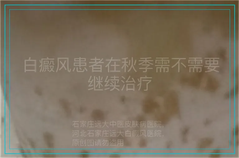 白癜风患者在秋季需不需要继续治疗