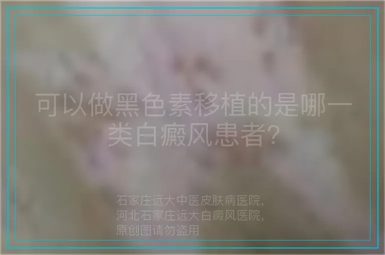 可以做黑色素移植的是哪一类白癜风患者?