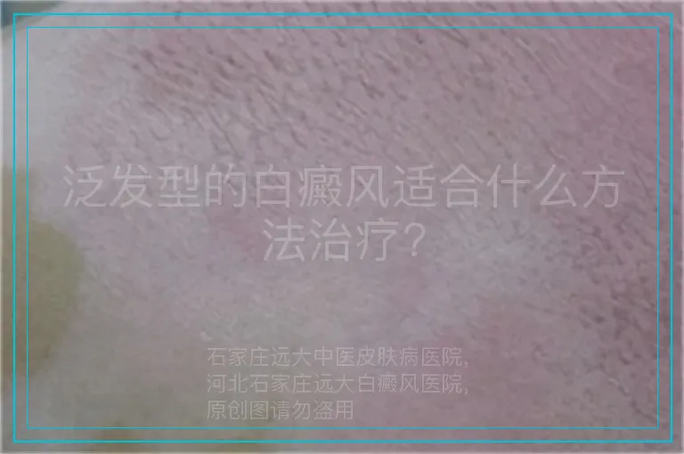 泛发型的白癜风适合什么方法治疗?