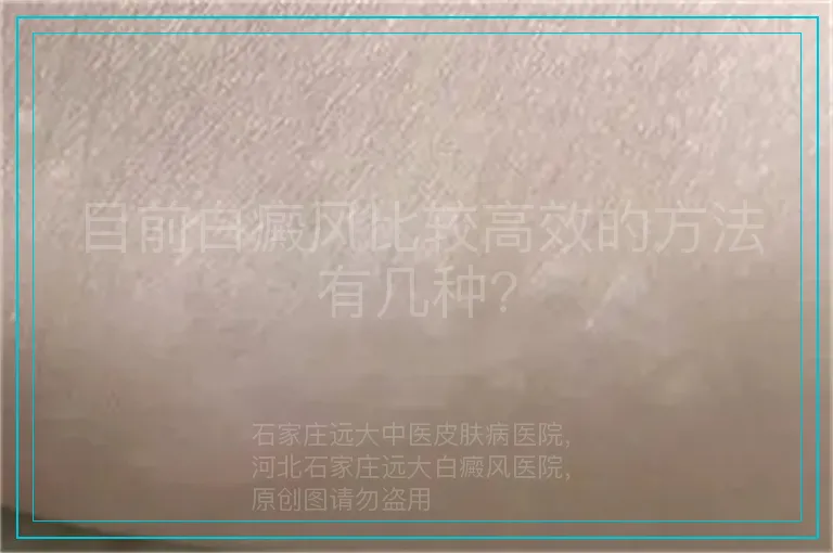 目前白癜风比较高效的方法有几种?