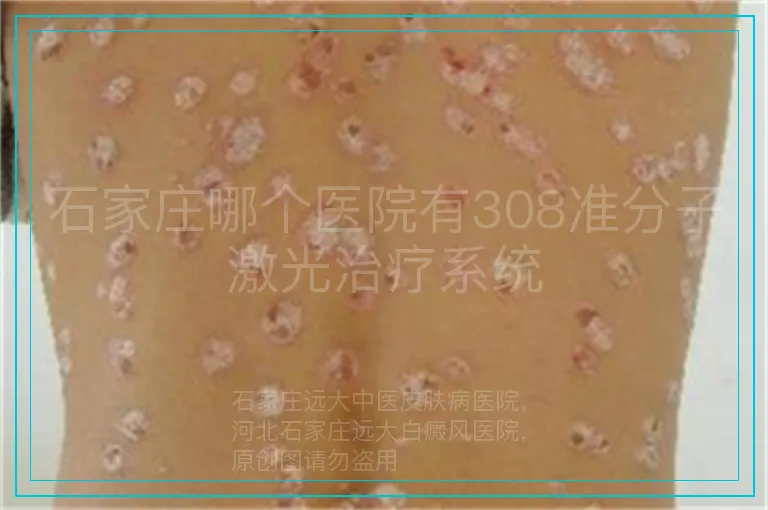 石家庄哪个医院有308准分子激光治疗系统