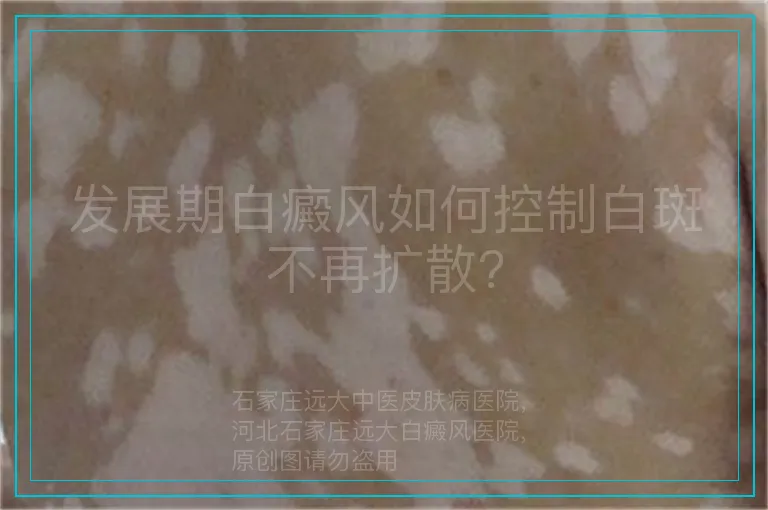 发展期白癜风如何控制白斑不再扩散?