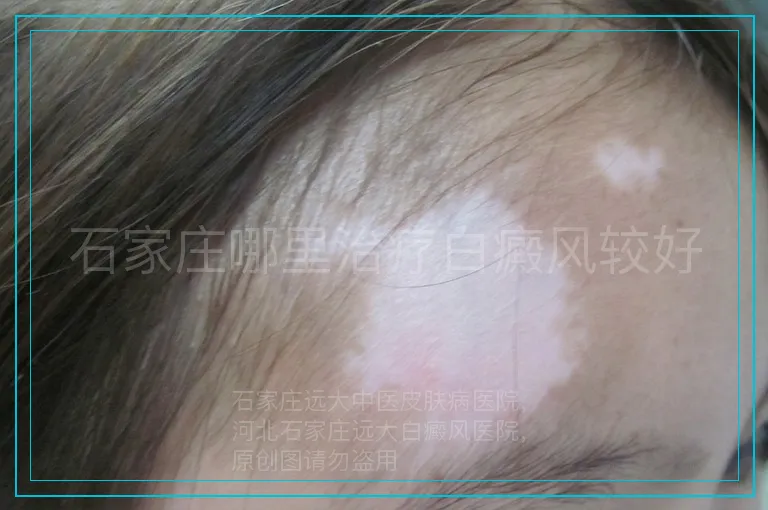 石家庄哪里治疗白癜风较好