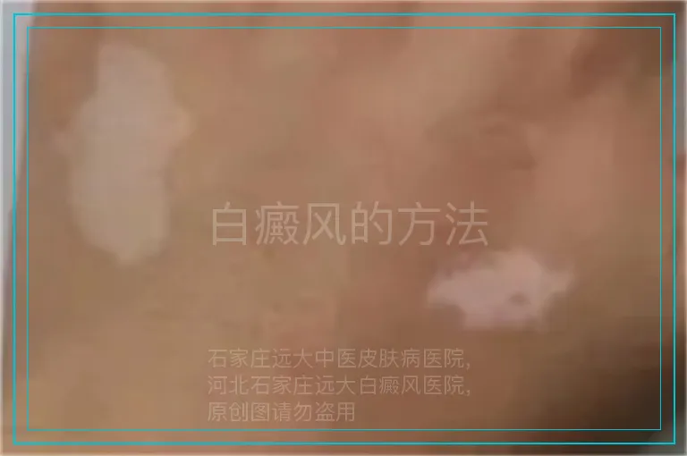 白癜风的方法