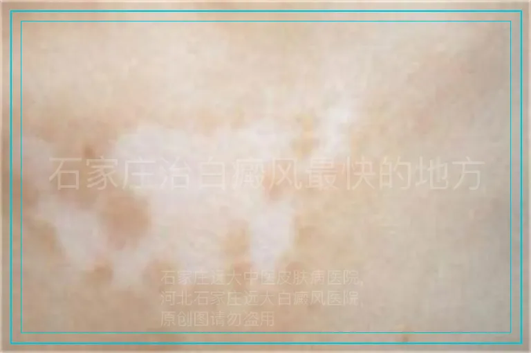 石家庄治白癜风最快的地方