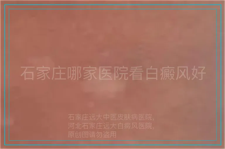 石家庄哪家医院看白癜风好
