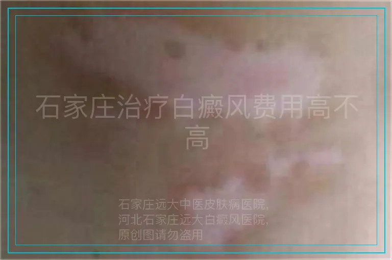石家庄治疗白癜风费用高不高