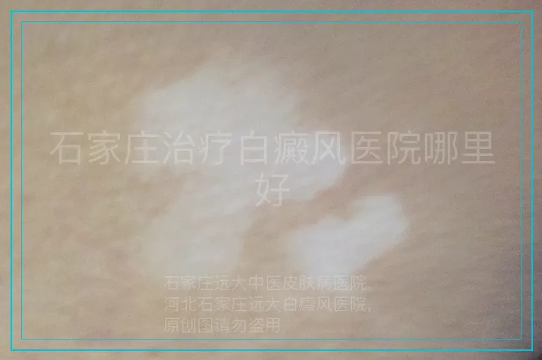石家庄治疗白癜风医院哪里好