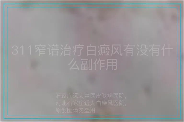 311窄谱治疗白癜风有没有什么副作用