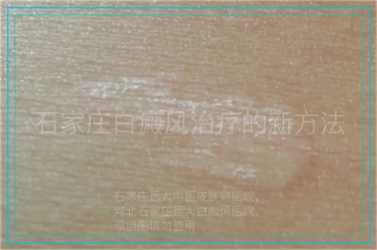 石家庄白癜风治疗的新方法