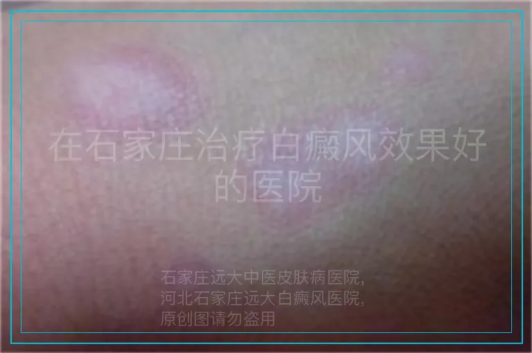 在石家庄治疗白癜风效果好的医院