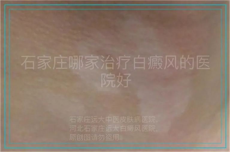 石家庄哪家治疗白癜风的医院好