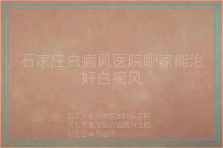石家庄白癜风医院哪家能治好白癜风