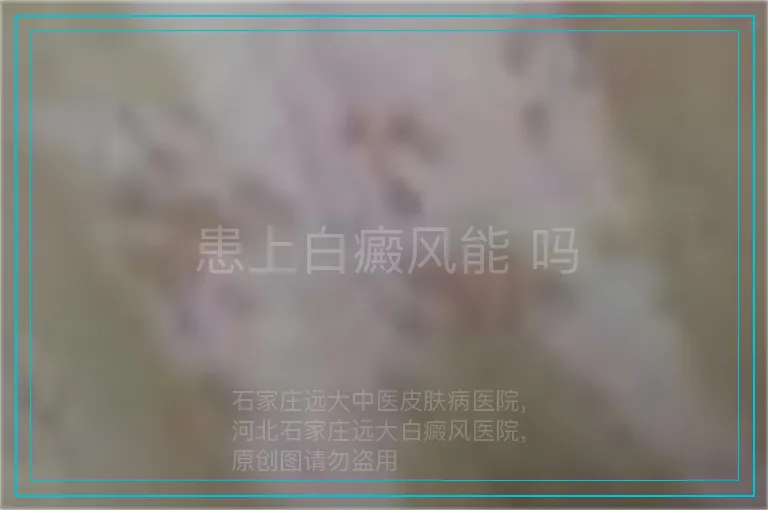 患上白癜风能 吗