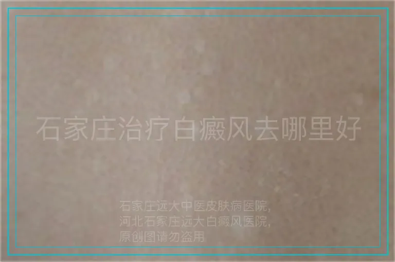 石家庄治疗白癜风去哪里好