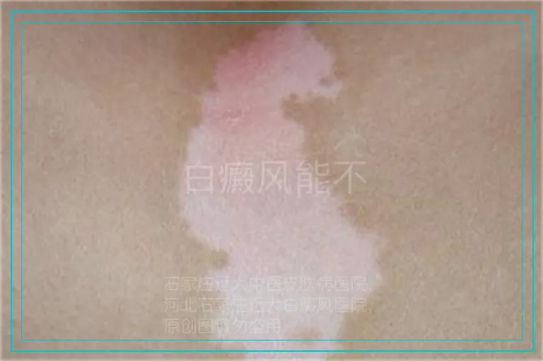 白癜风能不