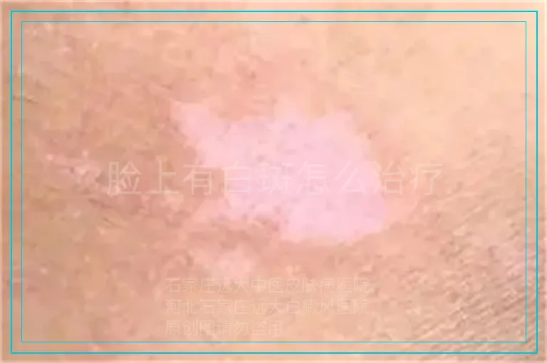 脸上有白斑怎么治疗