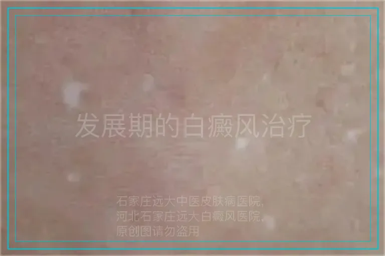 发展期的白癜风治疗