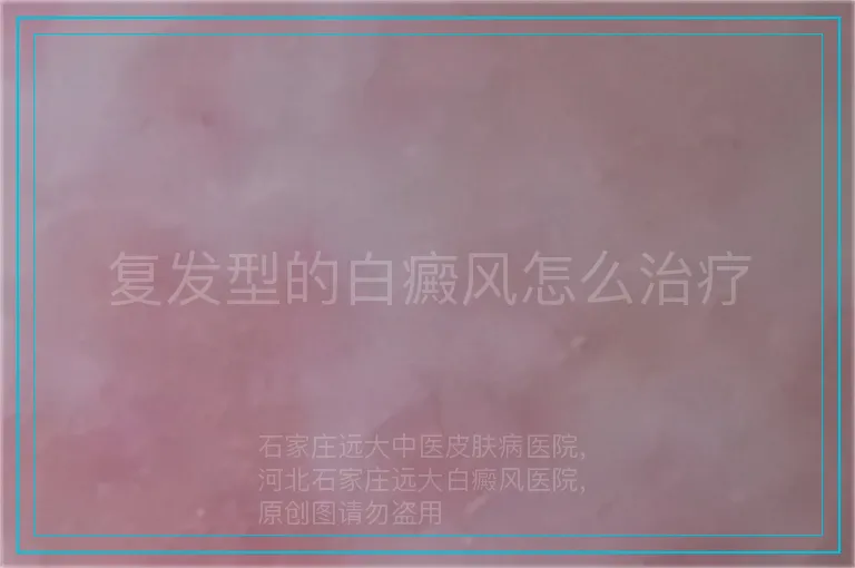 复发型的白癜风怎么治疗