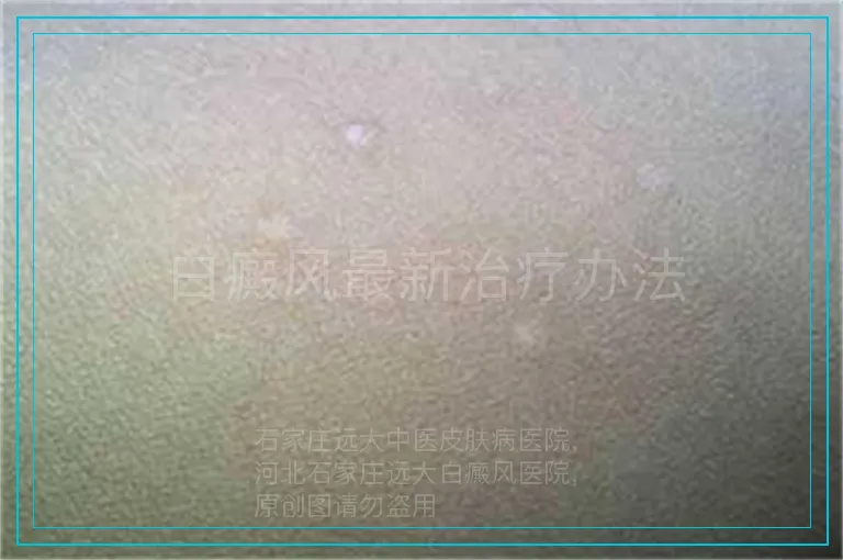 白癜风最新治疗办法