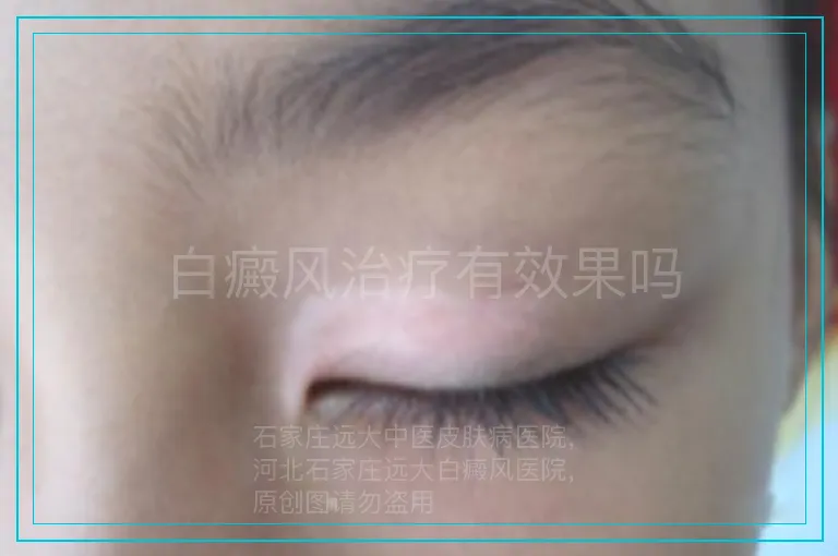 白癜风治疗有效果吗