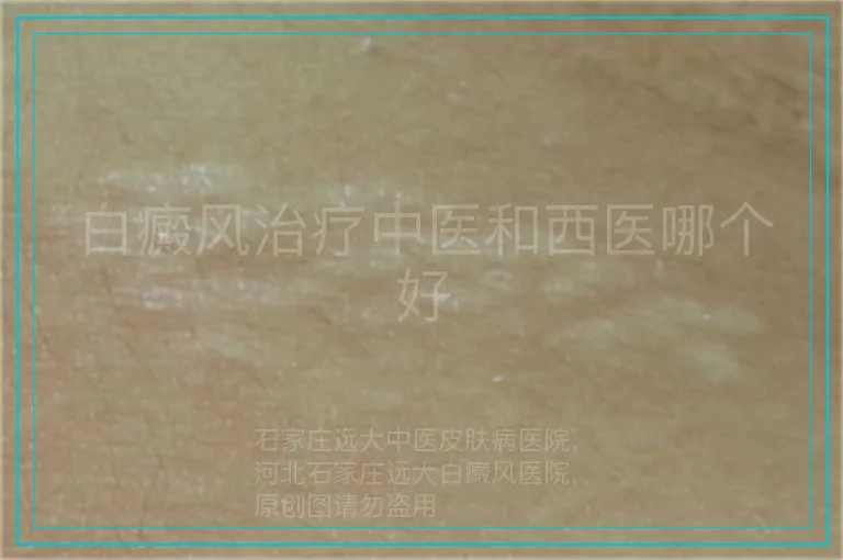 白癜风治疗中医和西医哪个好