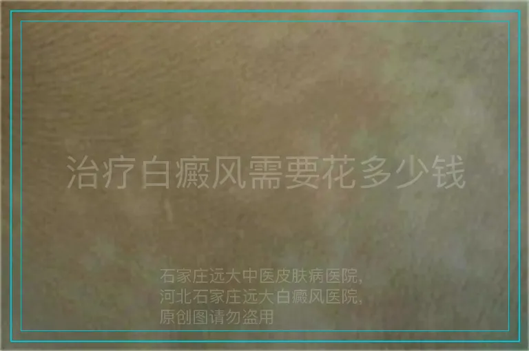 治疗白癜风需要花多少钱