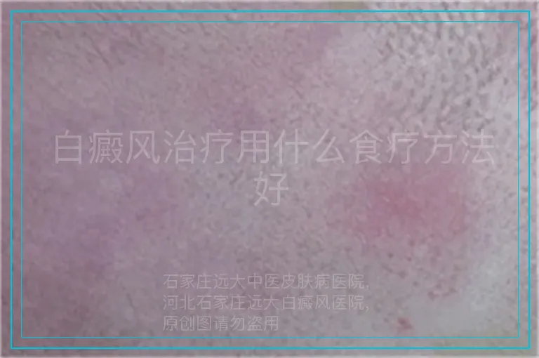 白癜风治疗用什么食疗方法好
