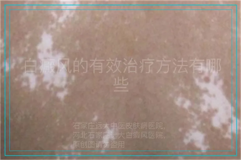 白癜风的有效治疗方法有哪些