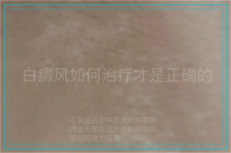 白癜风如何治疗才是正确的