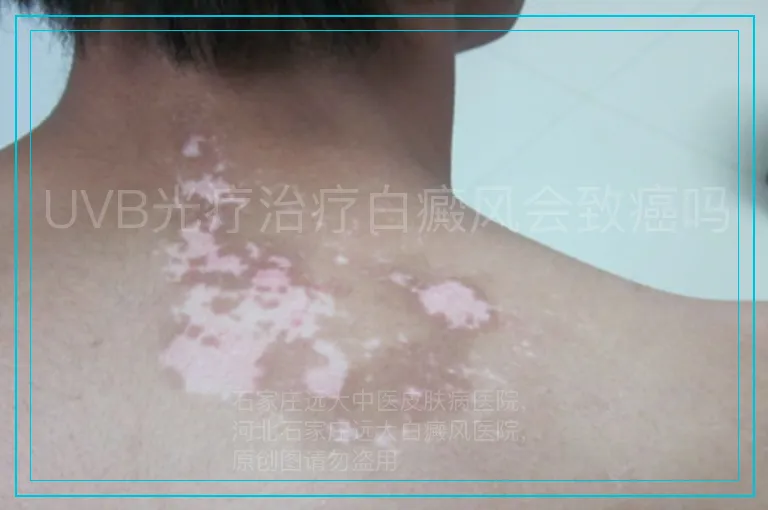 UVB光疗治疗白癜风会致癌吗
