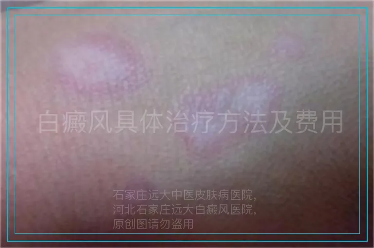 白癜风具体治疗方法及费用