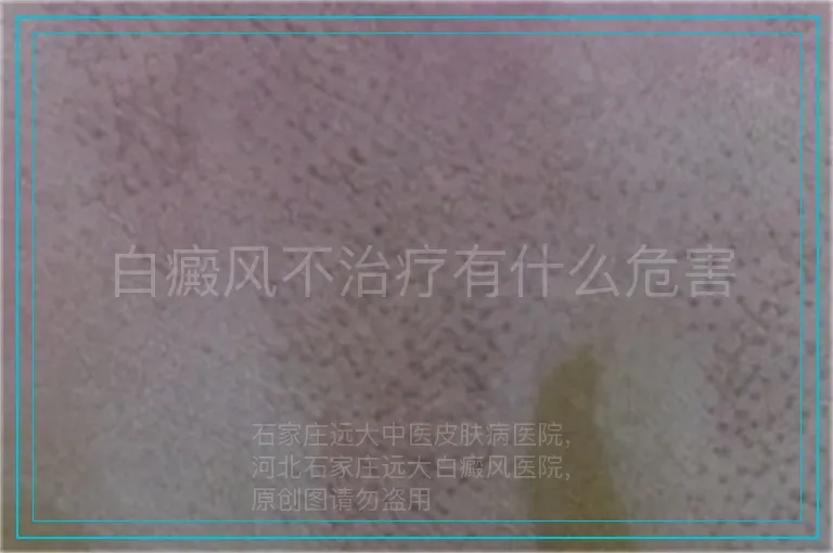 白癜风不治疗有什么危害