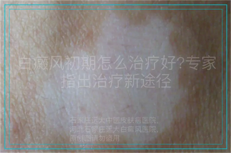 白癜风初期怎么治疗好?专家指出治疗新途径
