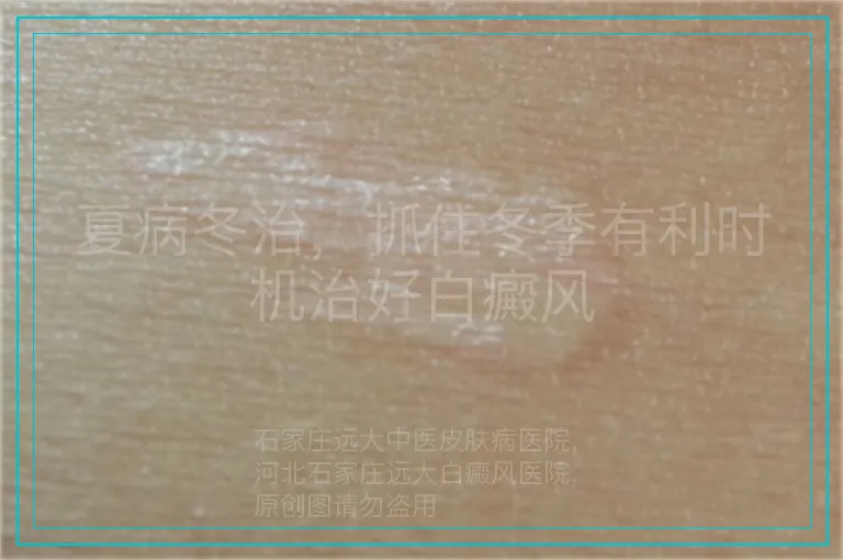 夏病冬治,抓住冬季有利时机治好白癜风