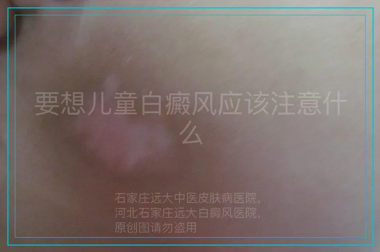 要想儿童白癜风应该注意什么