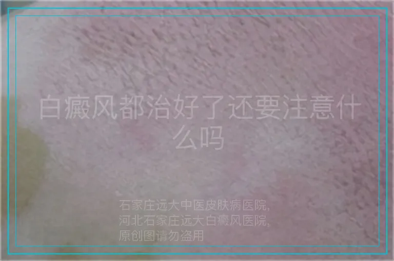白癜风都治好了还要注意什么吗