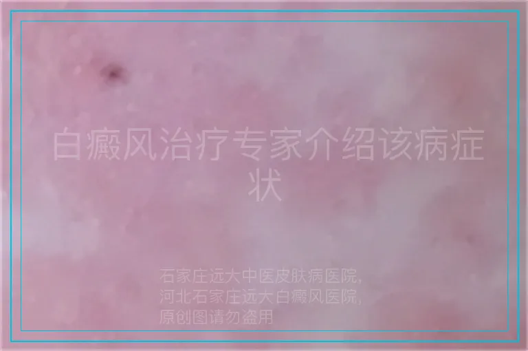 白癜风治疗专家介绍该病症状
