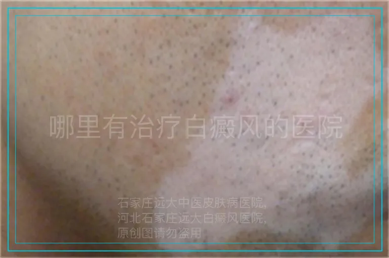 哪里有治疗白癜风的医院