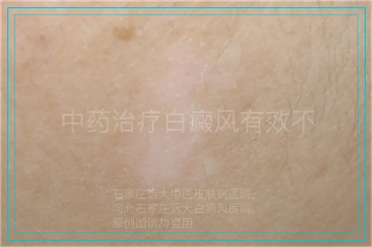 中药治疗白癜风有效不